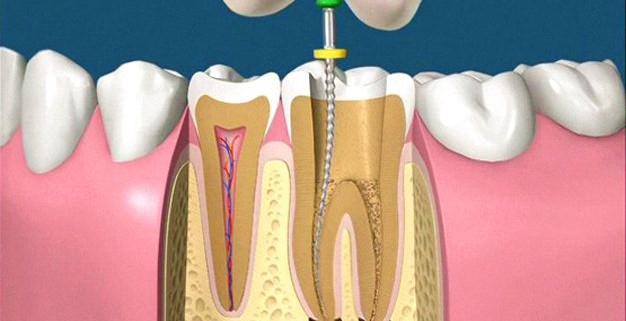 Perchè devitalizzare i denti?