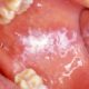 Lichen Planus orale