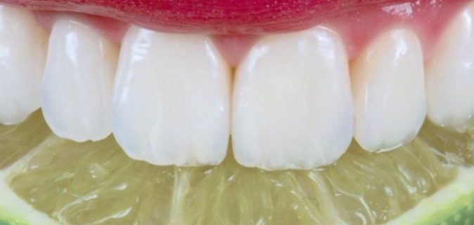 Lo smalto dentale: erosione e abrasione