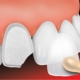 faccette dentali