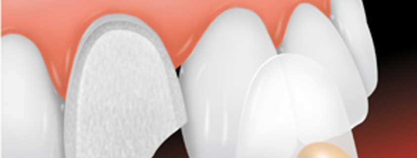 faccette dentali
