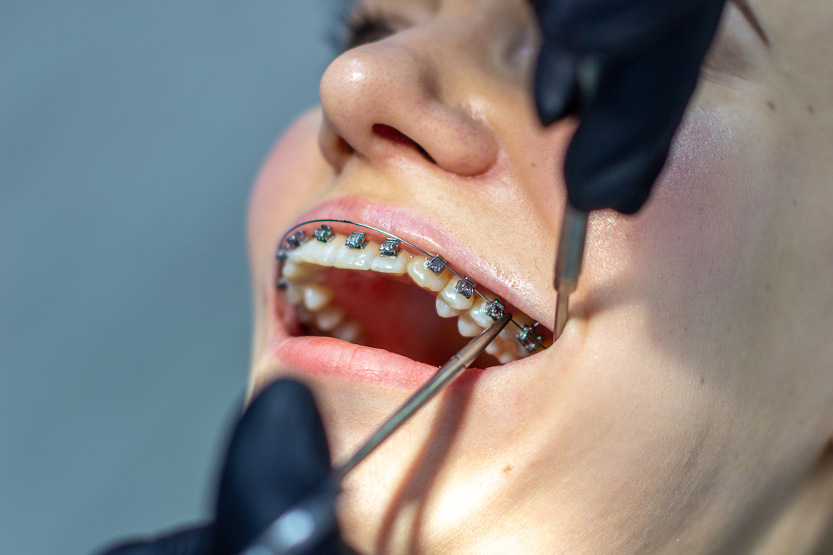 A woman with dental braces visits an orthodontist in the clinic, in a dental chair. during the procedure of installing the arch of braces on the upper and lower teeth. The dentist is wearing gloves and has dental instruments in his hands. The concept of dentistry