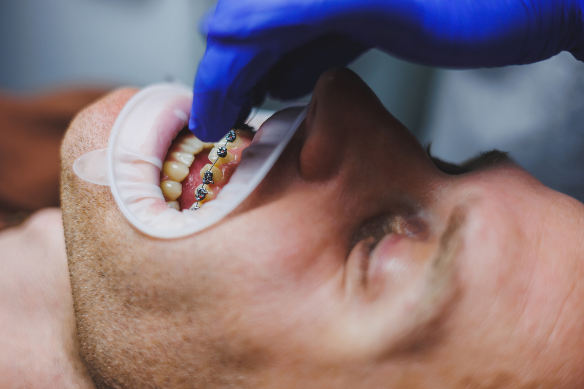Dental treatment of teeth. A young man at a dentist's appointment. The doctor installs metal braces on the teeth. Close-up of teeth with braces
